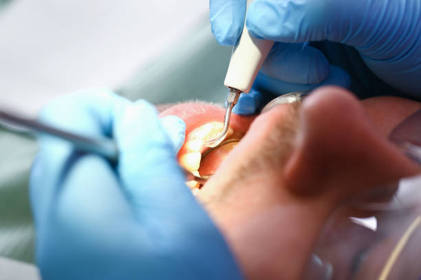 Best Emergency Treatment for Dental Infections or Abscesses in Artondale, WA